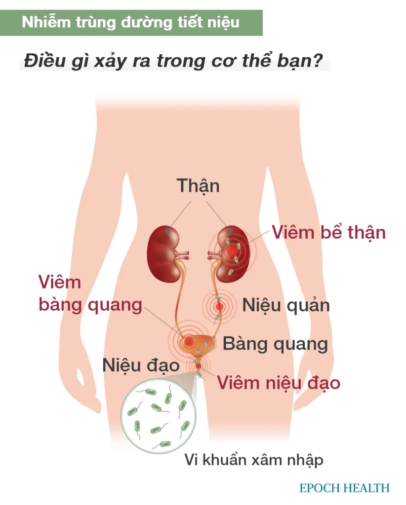 Hướng dẫn cơ bản về bệnh nhiễm trùng đường tiết niệu: Triệu chứng, nguyên nhân, cách điều trị và các phương pháp tự nhiên