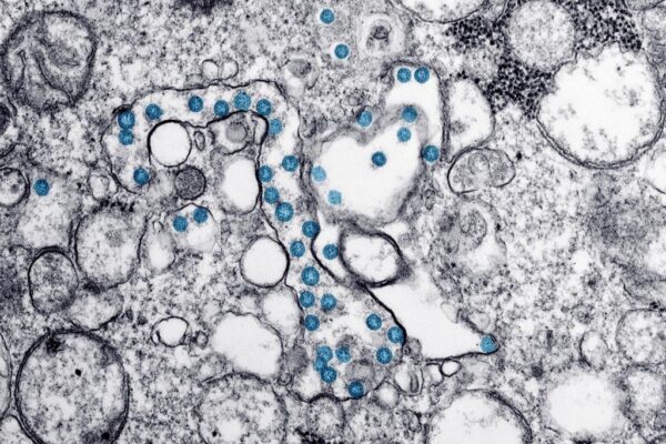 Hình ảnh từ kính hiển vi điện tử do Trung tâm Kiểm soát và Phòng ngừa Dịch bệnh Hoa Kỳ cung cấp cho thấy các hạt hình cầu trong mẫu bệnh phẩm của bệnh nhân bị COVID-19 đầu tiên ở Hoa Kỳ. (Ảnh: Báo chí Canada/AP-Hannah A. Bullock, Azaibi Tamin/CDC qua AP)