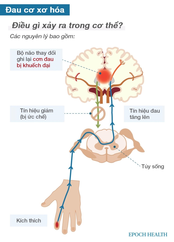 Hướng dẫn cơ bản về chứng đau cơ xơ hóa: Triệu chứng, nguyên nhân, cách điều trị và các phương pháp tự nhiên