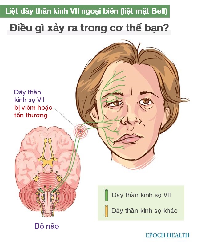 Hướng dẫn cơ bản về liệt dây thần kinh VII ngoại biên: Triệu chứng, nguyên nhân, điều trị và cách tiếp cận tự nhiên