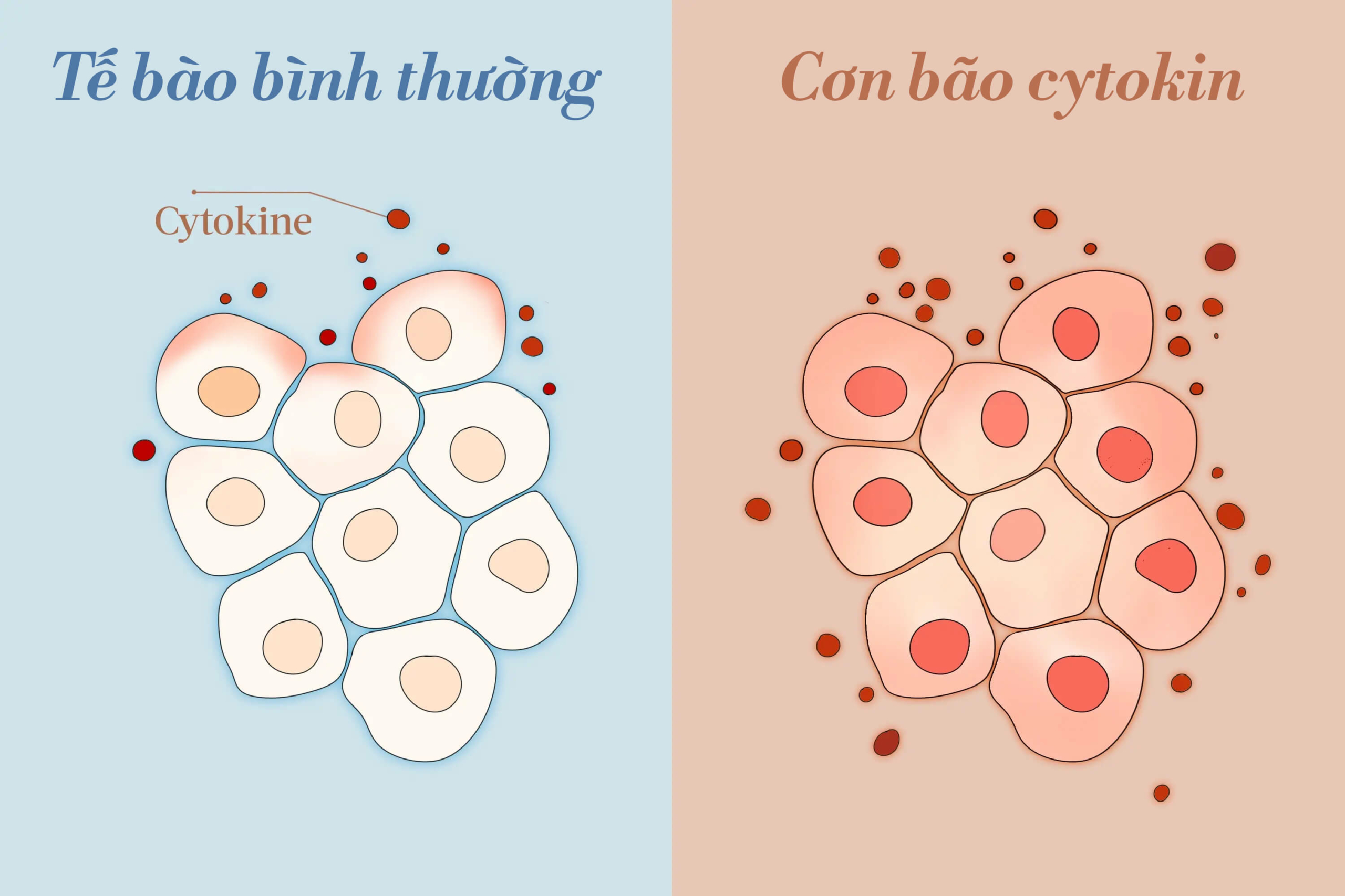 So sánh các tế bào tiếp xúc với tình trạng viêm thông thường và cơn bão cytokine. (Ảnh: The Epoch Times)