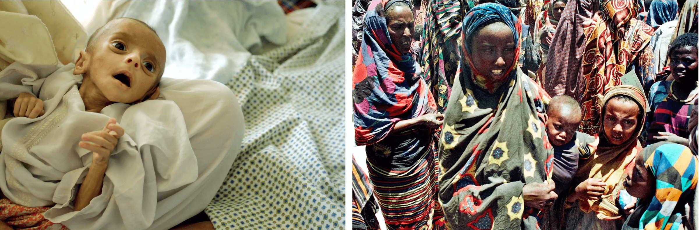 (Giữa) Suy dinh dưỡng là nguyên nhân chính khiến trẻ em tử vong vì bệnh sởi. Một em bé 4 tháng tuổi bị suy dinh dưỡng nặng nằm trên giường bệnh viện ở Kabul, Afghanistan, ngày 16/07/2002. (Ảnh: Natalie Behring-Chisholm/Getty; (Phải) Những bà mẹ và trẻ em Somali đang chờ nhận thức ăn từ trung tâm cung cấp thực phẩm của UNICEF ở Wajid, một thị trấn ở miền nam Somalia, ngày 13/04/2000. Somalia có tỷ lệ tử vong ở trẻ sơ sinh và trẻ em cao nhất thế giới vì nhiều bệnh, trong đó có bệnh sởi. (Ảnh: ALI MUSA/AFP/Getty Images)