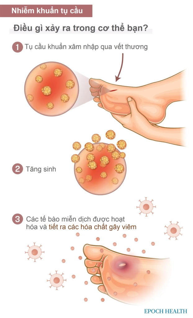 Hướng dẫn cơ bản về nhiễm khuẩn tụ cầu: Triệu chứng, nguyên nhân, điều trị và phương pháp tiếp cận tự nhiên