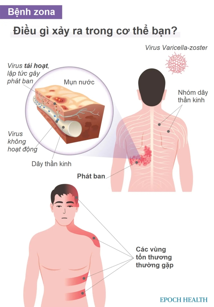 Hướng dẫn cơ bản về bệnh Zona (Herpes Zoster): Triệu chứng, nguyên nhân, điều trị và các cách tiếp cận tự nhiên