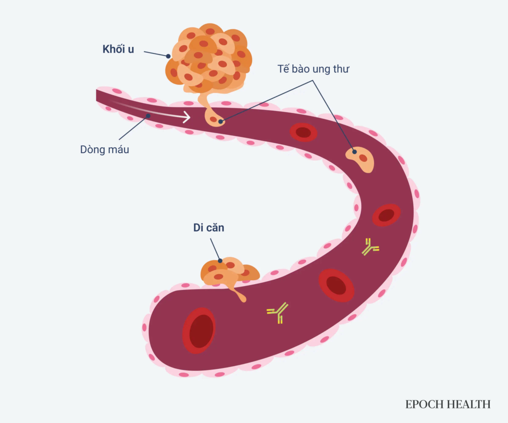 Ung thư có thể di căn hoặc lan rộng qua hệ tuần hoàn khi các tế bào ung thư từ khối u nguyên phát vỡ ra và di chuyển đến những nơi khác trong cơ thể. Quá trình này cũng có thể xảy ra trong hệ bạch huyết, nơi có mạng mạch tương tự như hệ tuần hoàn. (Ảnh: Shutterstock)