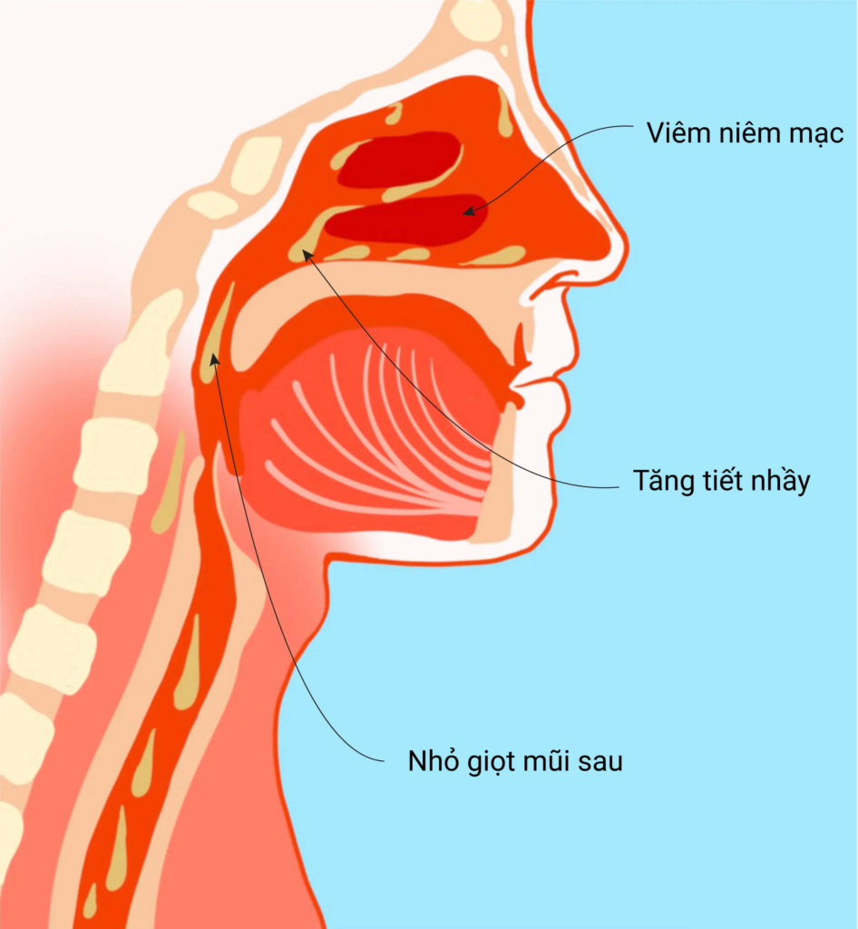 Hội chứng ho đường hô hấp trên là nguyên nhân phổ biến nhất gây ho mạn tính. (Minh họa của The Epoch Times, Shutterstock)