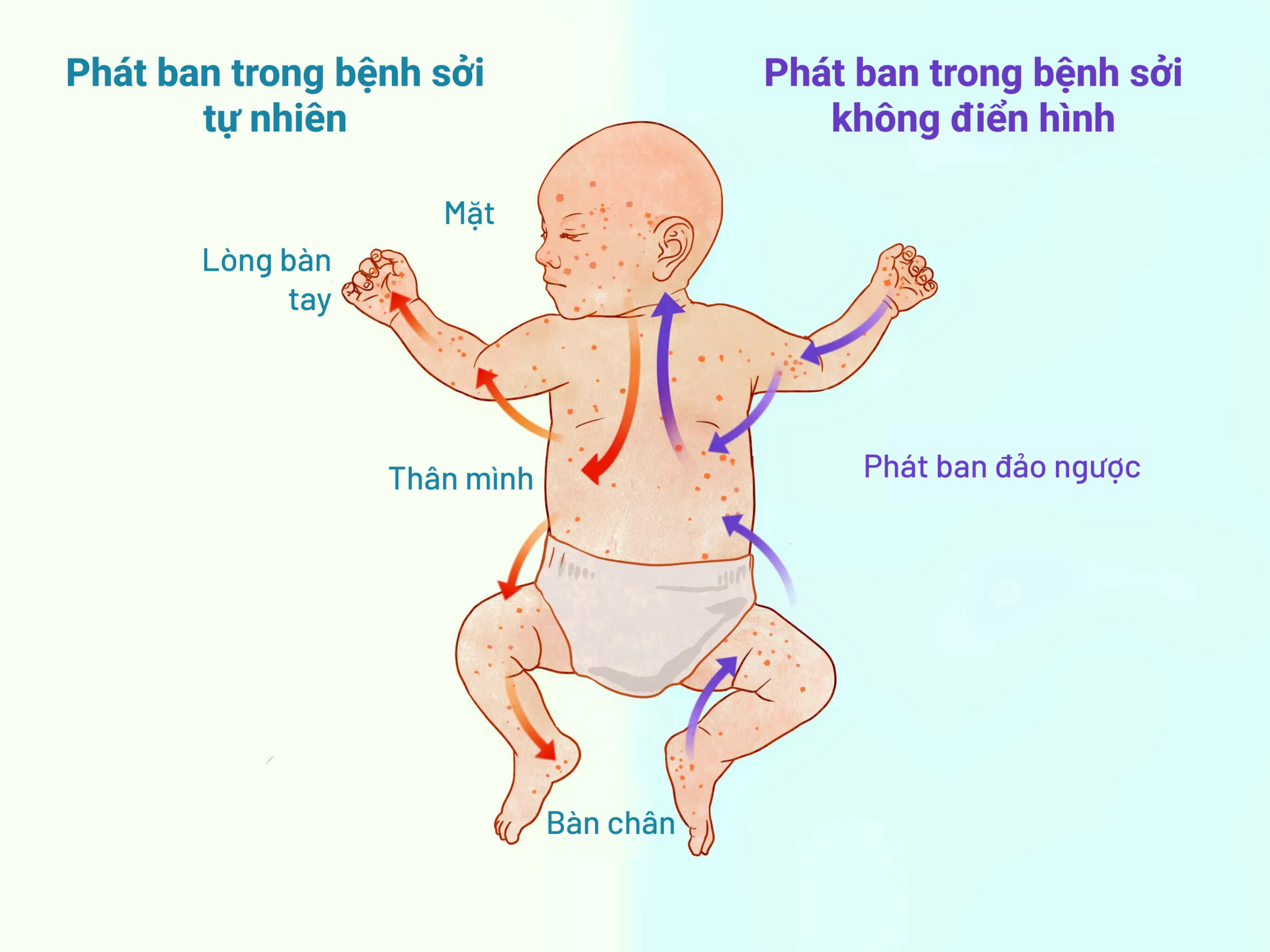 Phát ban trong bệnh sởi tự nhiên thường bắt đầu trên mặt và lan ra các chi. Phát ban trong bệnh sởi không điển hình bắt đầu ở tứ chi và lan lên mặt. (Minh họa của The Epoch Times)