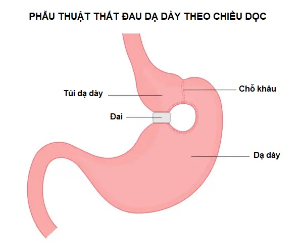 Tác dụng phụ của phẫu thuật giảm cân ám ảnh nhiều người