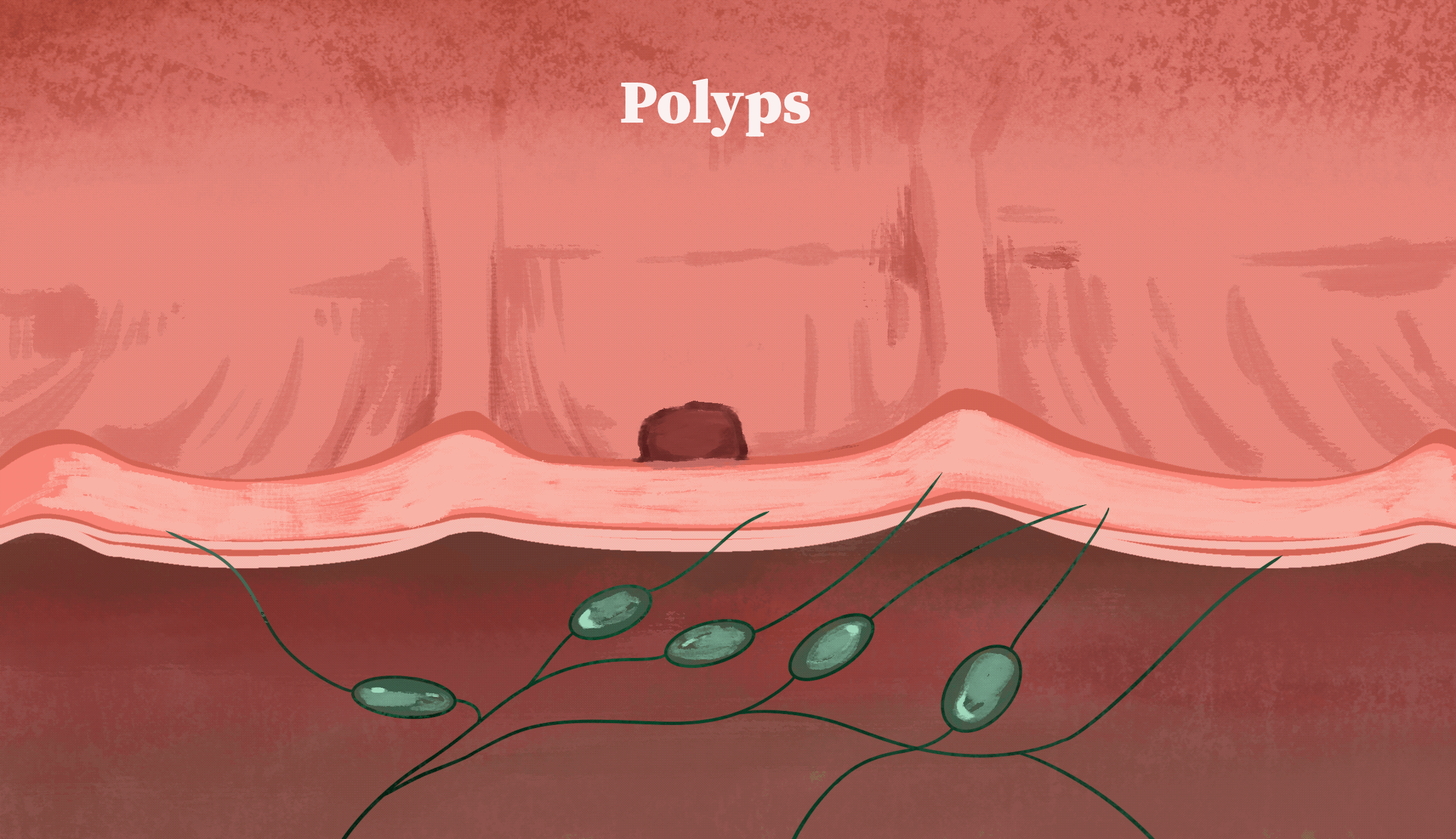 Ung thư đại trực tràng phát triển từ polyps như thế nào. (Ảnh minh họa bởi The Epoch Times)