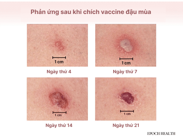 Phản ứng trên da sau vài tuần chích vaccine đậu mùa được dùng để đánh giá hiệu quả của việc chích ngừa. (Ảnh: CDC/Getty Images)