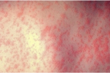 Bệnh sởi tái phát ở Sài Gòn sau hơn một năm không ghi nhận thêm ca mới