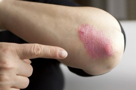 Nghiên cứu: Kỹ năng đối phó với căng thẳng kém làm tăng nguy cơ mắc bệnh vẩy nến