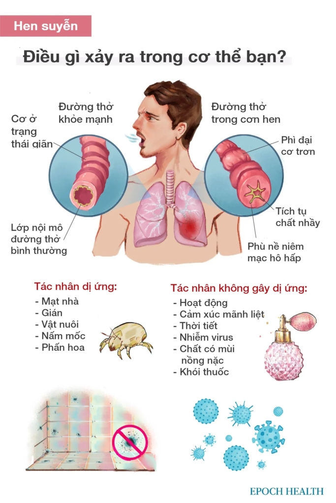 Hướng dẫn cơ bản về bệnh hen suyễn: Triệu chứng, nguyên nhân, điều trị và các cách tiếp cận tự nhiên