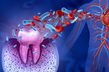 Nghiên cứu: Điều trị bệnh nướu răng có thể phòng ngừa loạn nhịp tim tái phát