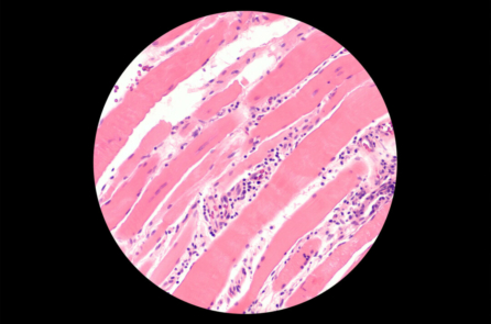 Nghiên cứu: Báo cáo ngày càng tăng về bệnh tự miễn hiếm gặp, COVID-19 và vaccine COVID-19 góp phần vào