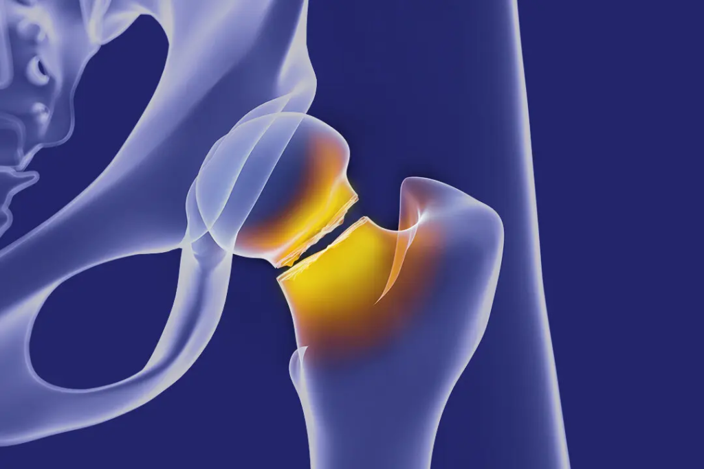 5 bài tập chuyên biệt dành cho người bị loãng xương