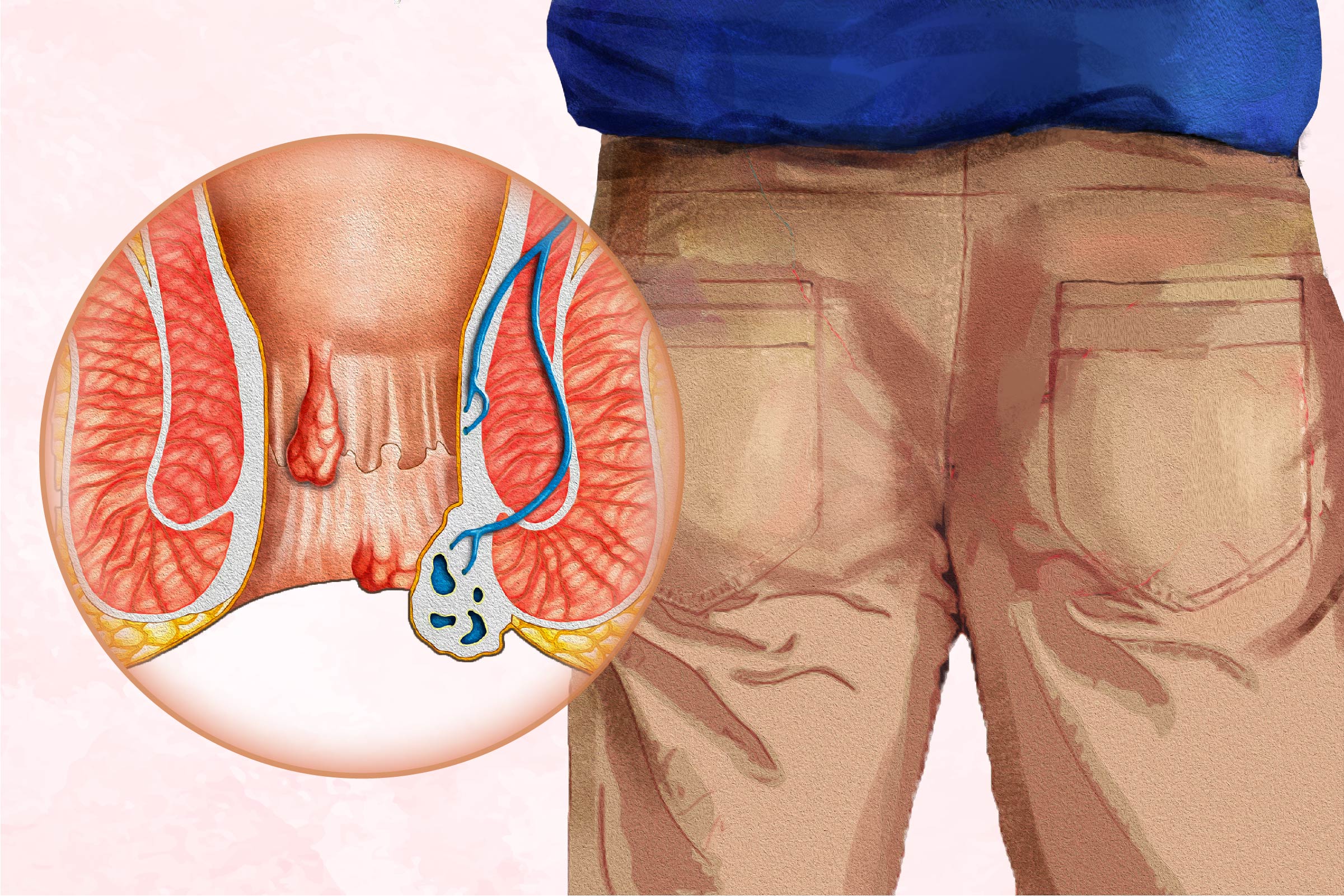 Bệnh trĩ: Triệu chứng, nguyên nhân, phương pháp điều trị và phương pháp tiếp cận tự nhiên
